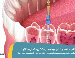 درباره عصب کشی دندان