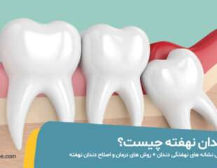 دندان نهفته