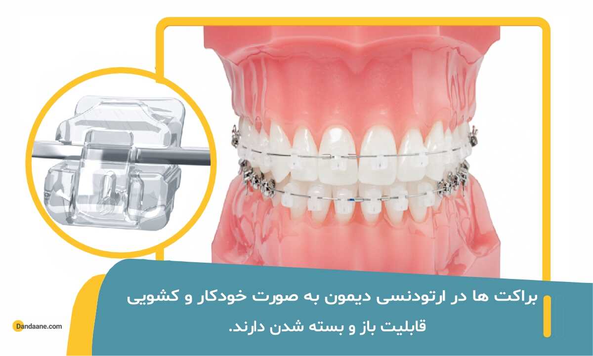 در ارتودنسی دیمون براکت ها به صورت کشویی قابلیت باز و بسته شدن را دارند. 