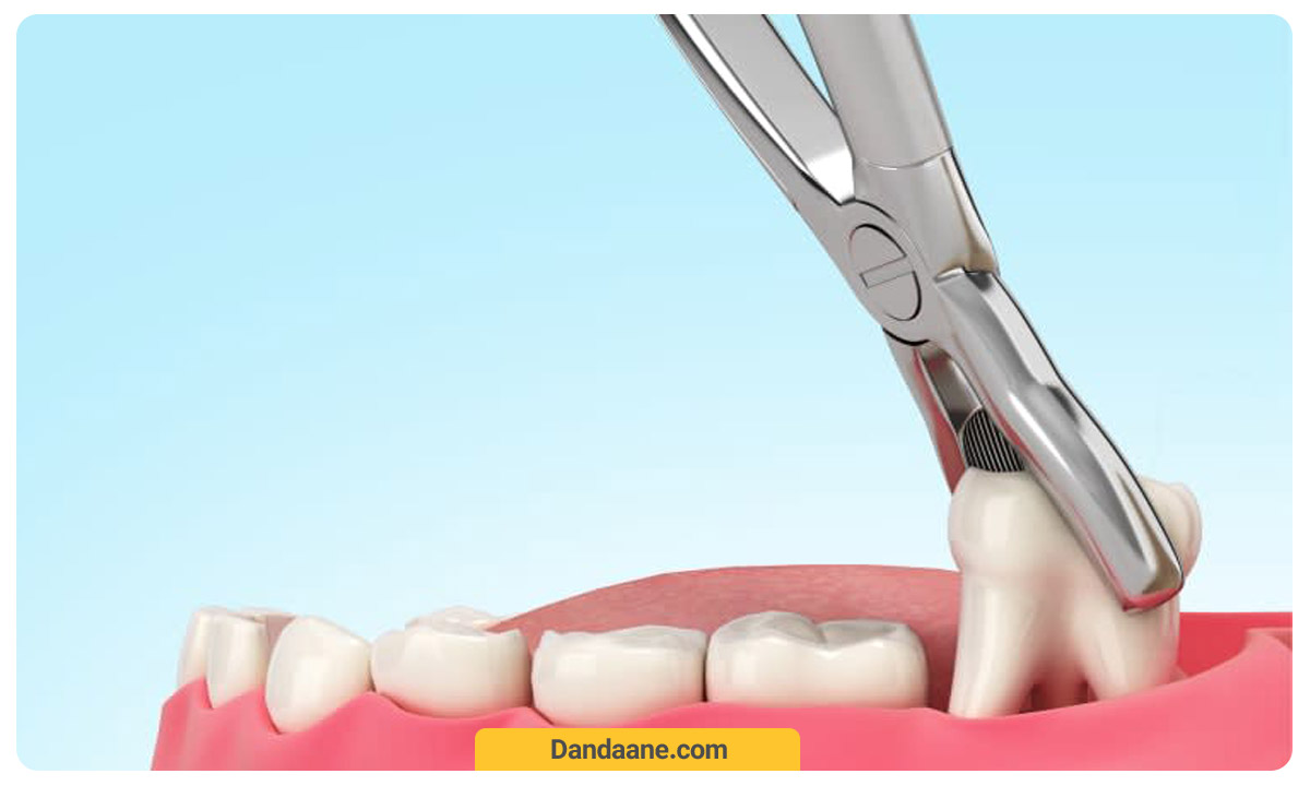 در کشیدن دندان به روش معمولی، بیمار کمی فشار بر دندان را احساس می کند