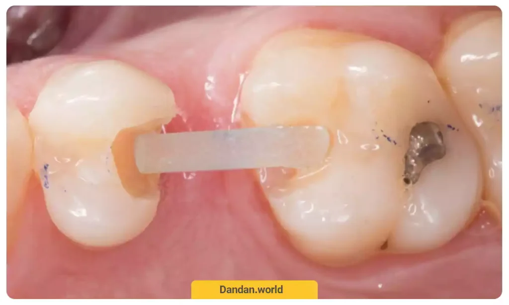 اف آر سی (FRC)