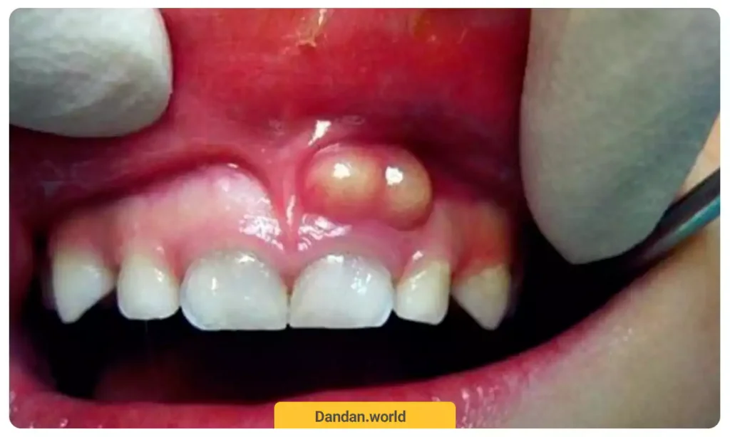 تصویر آبسه دندانی