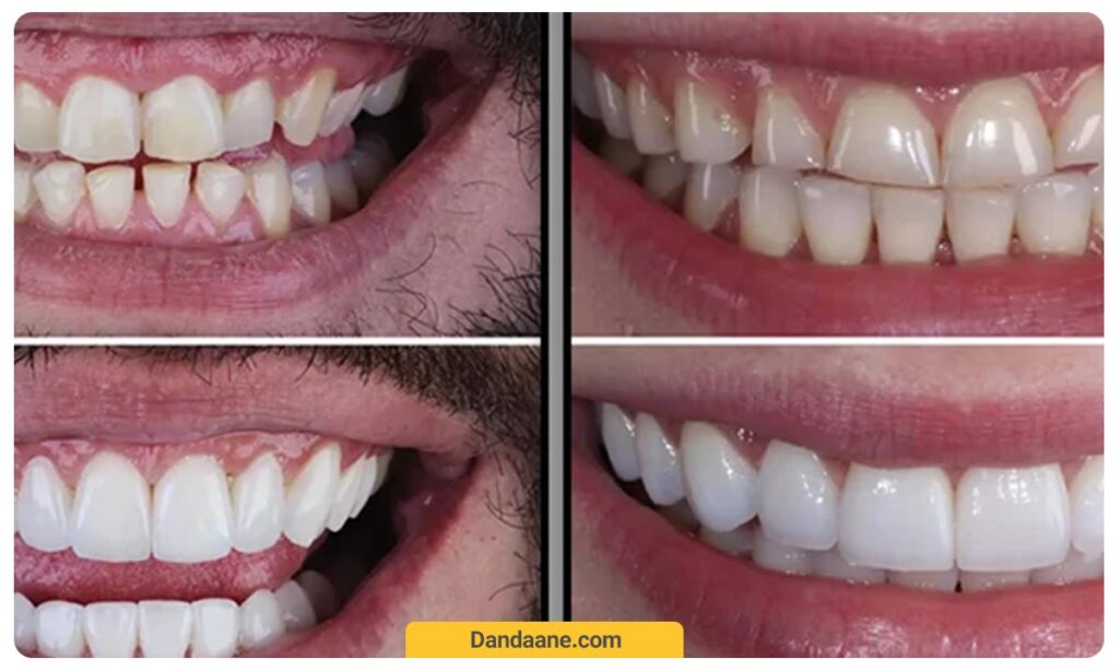 تفاوت عکس قبل و بعد قرارگیری کامپوزیت و لمینت دندان