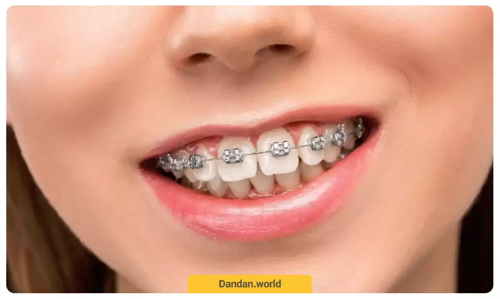 عکسی از خانمی که دارای بریس و براکت های ارتودنسی ثابت است