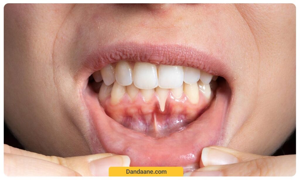 عکسی از پس روی لثه ها