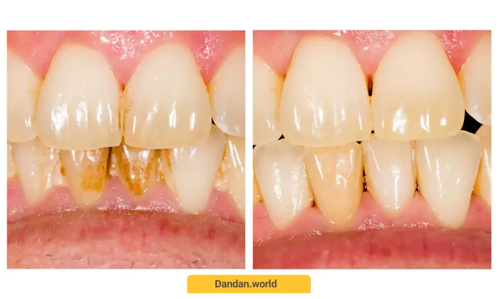 قبل و بعد جرم گیری دندان