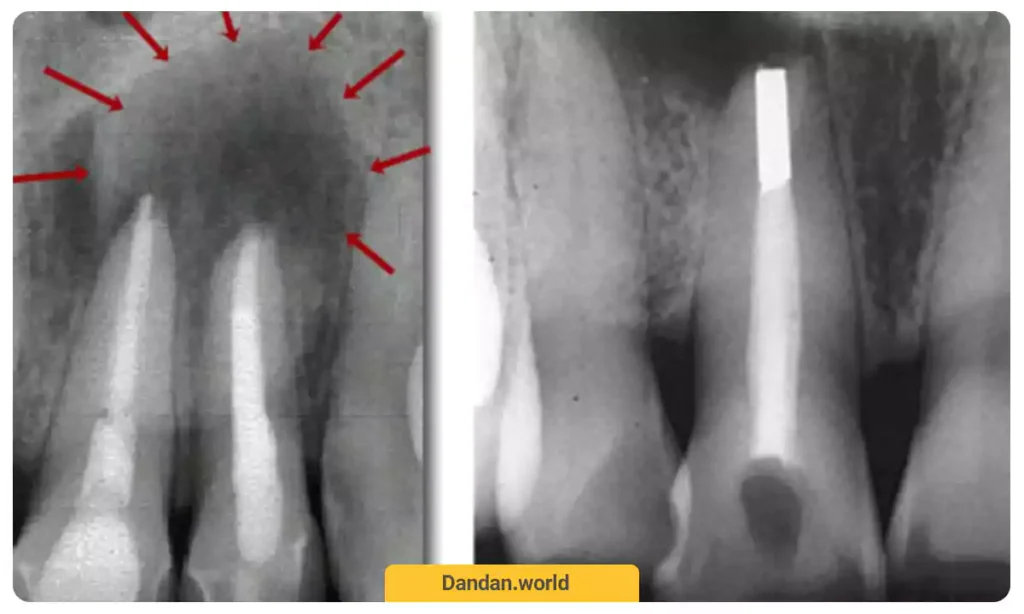 پرکردن ریشه دندان به صورت رتروگراد