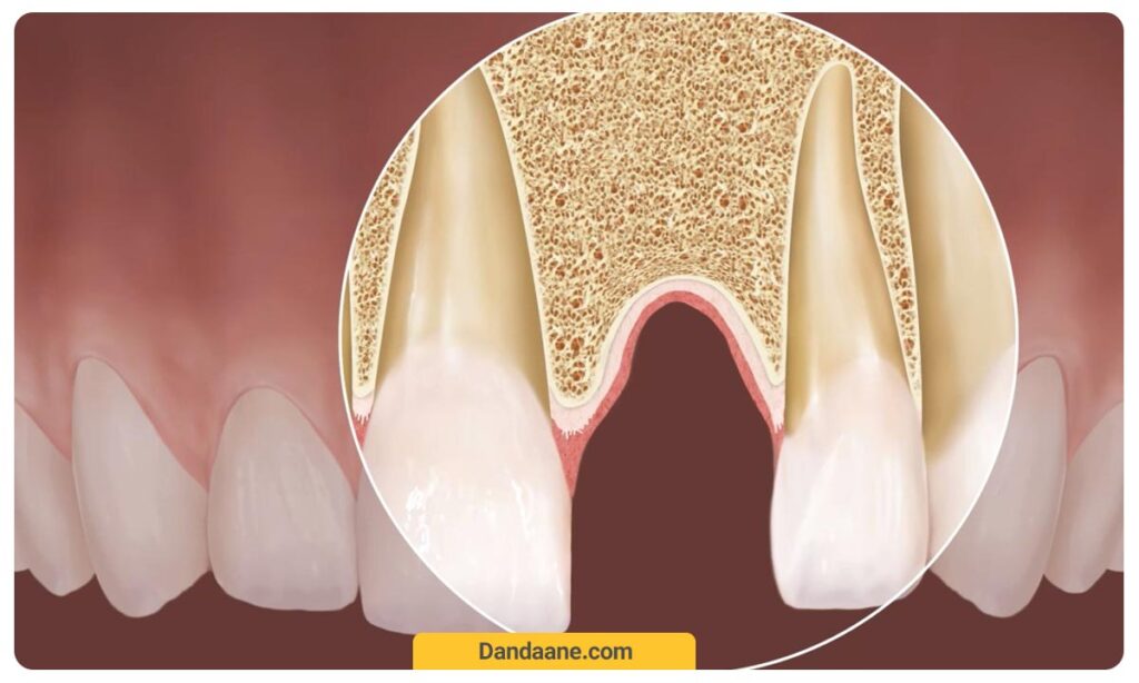 تضعیف ساختار استخوان فک