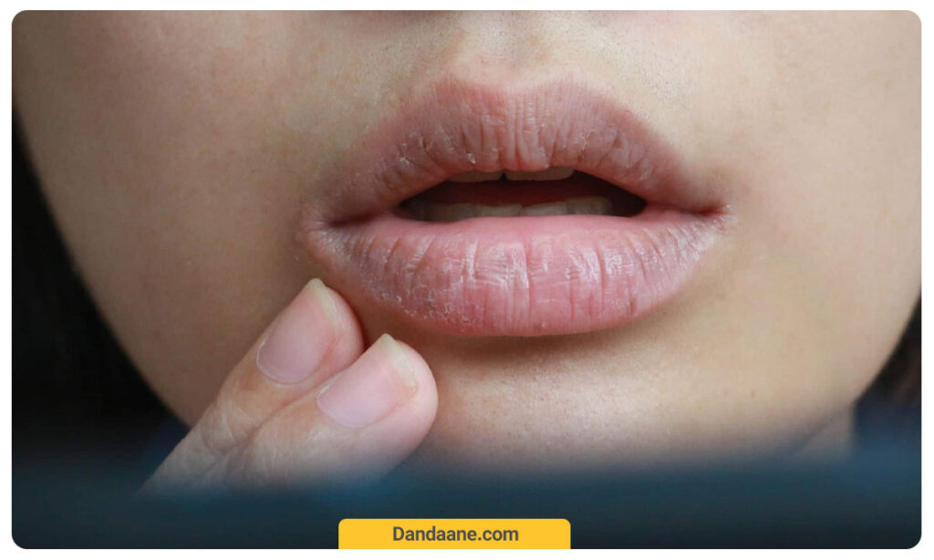 عکسی از خشکی دهان