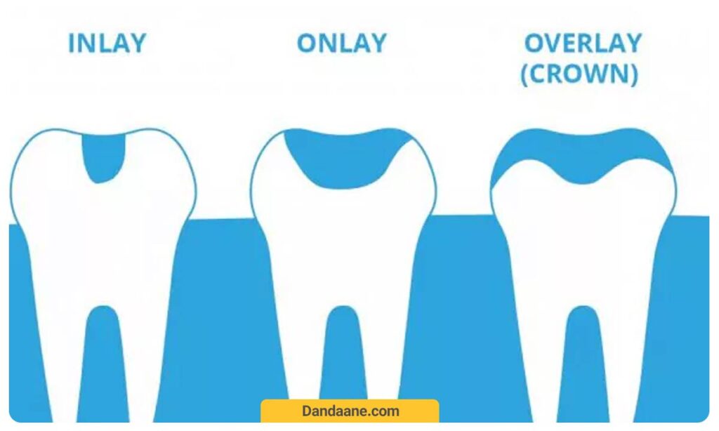 اینله و انله 