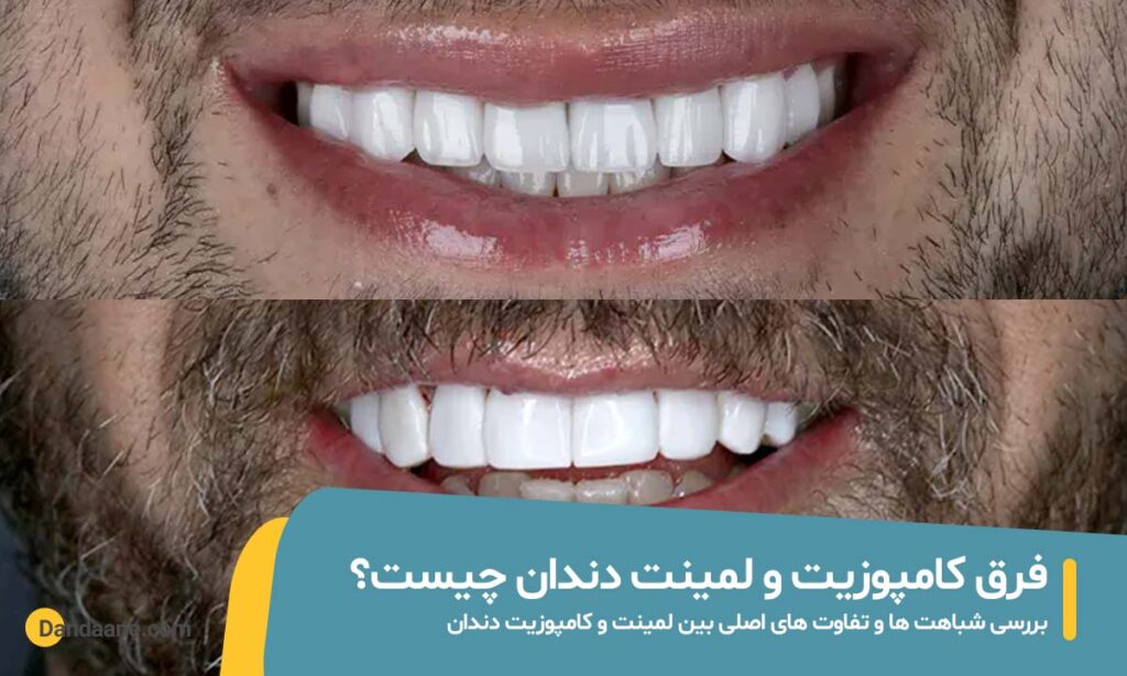 فرق کامپوزیت و لمینت دندان