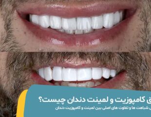 فرق کامپوزیت و لمینت دندان