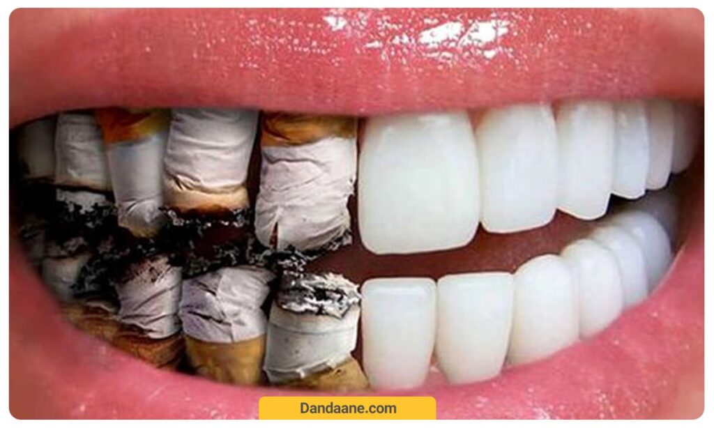 ارتباط بین سیگار و کامپوزیت دندان