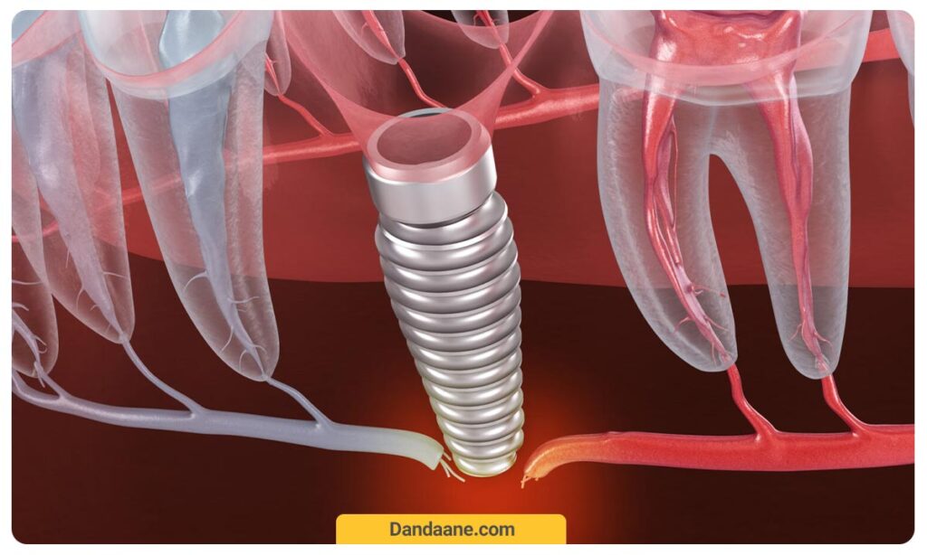 افتادن ایمپلنت دندان