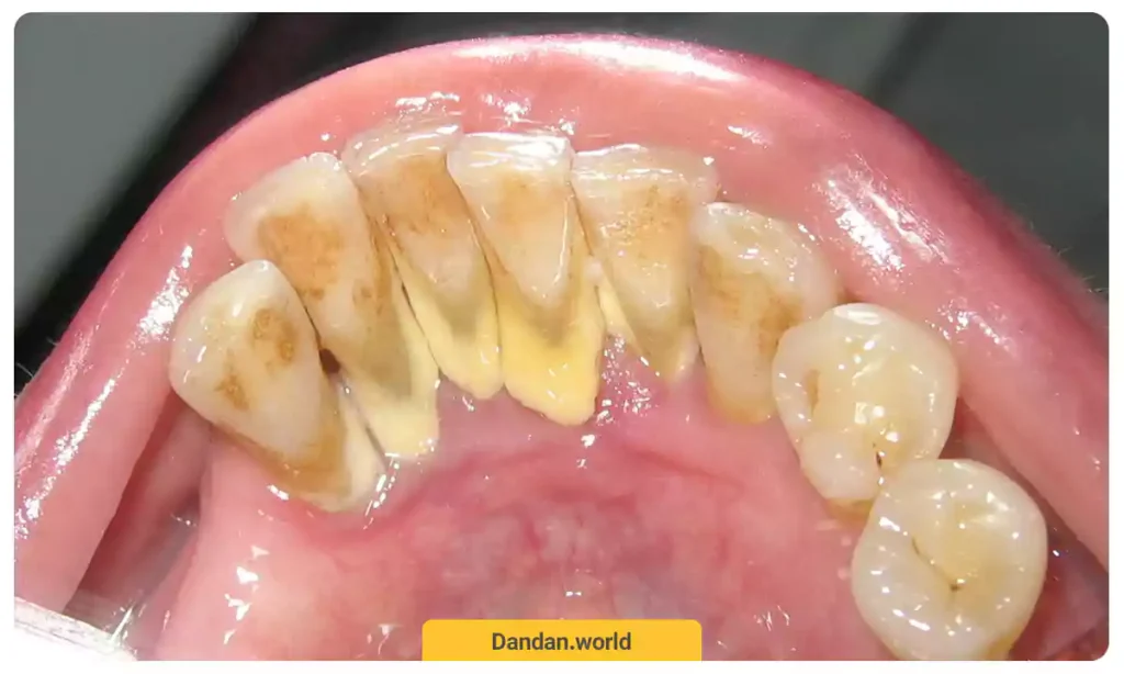 تجمع پلاک های دندانی