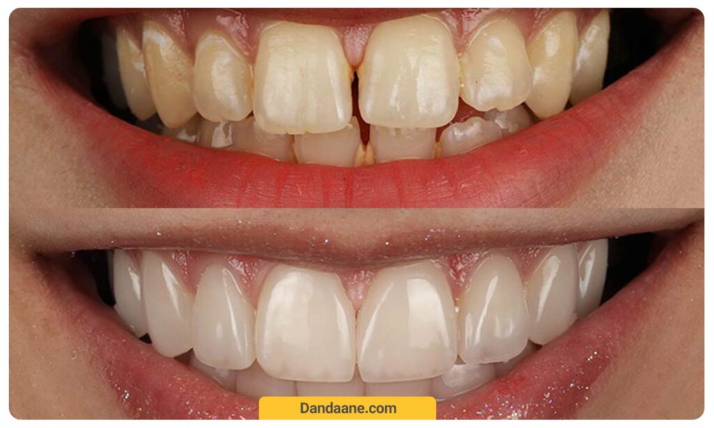 تصویر قبل و بعد کامپوزیت هیبریدی