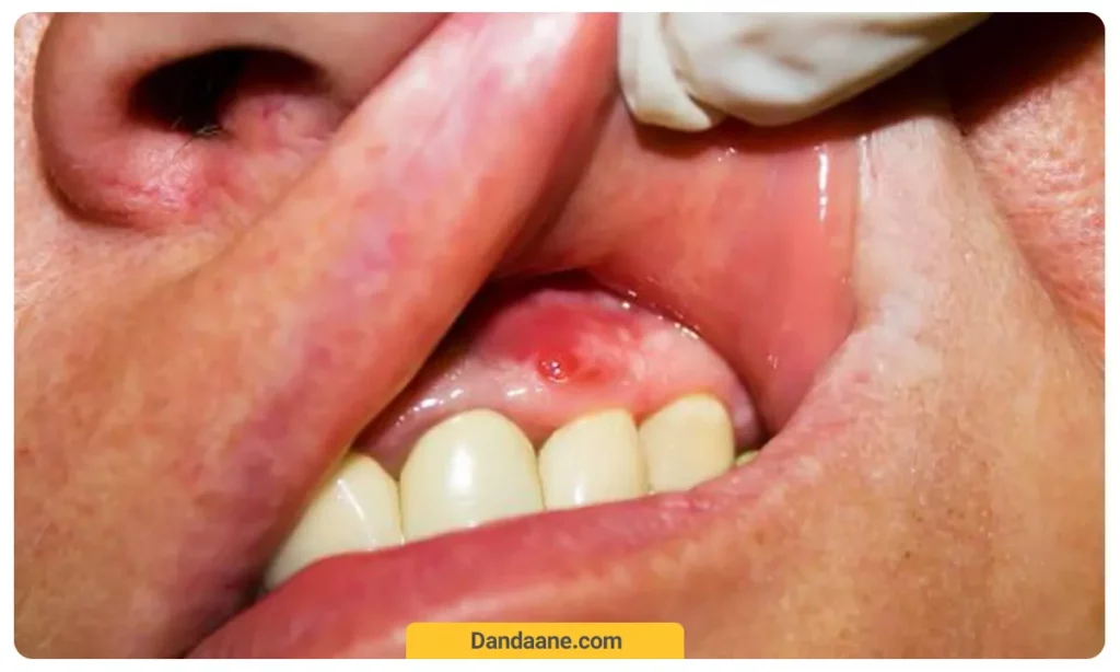 عکسی از التهاب لثه