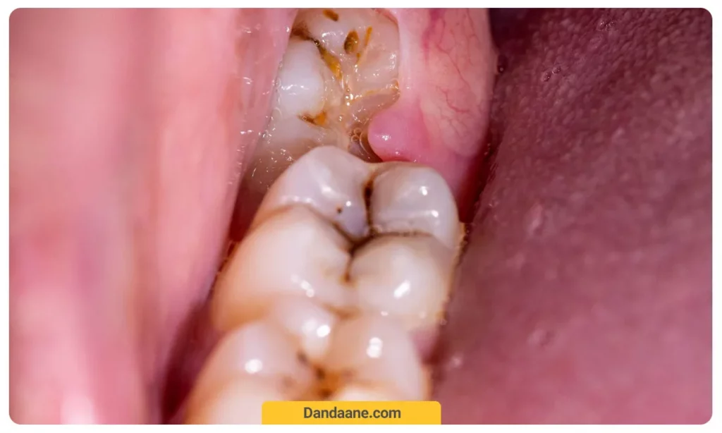 عکسی از نیازمندی دندان عقل به عصب کشی