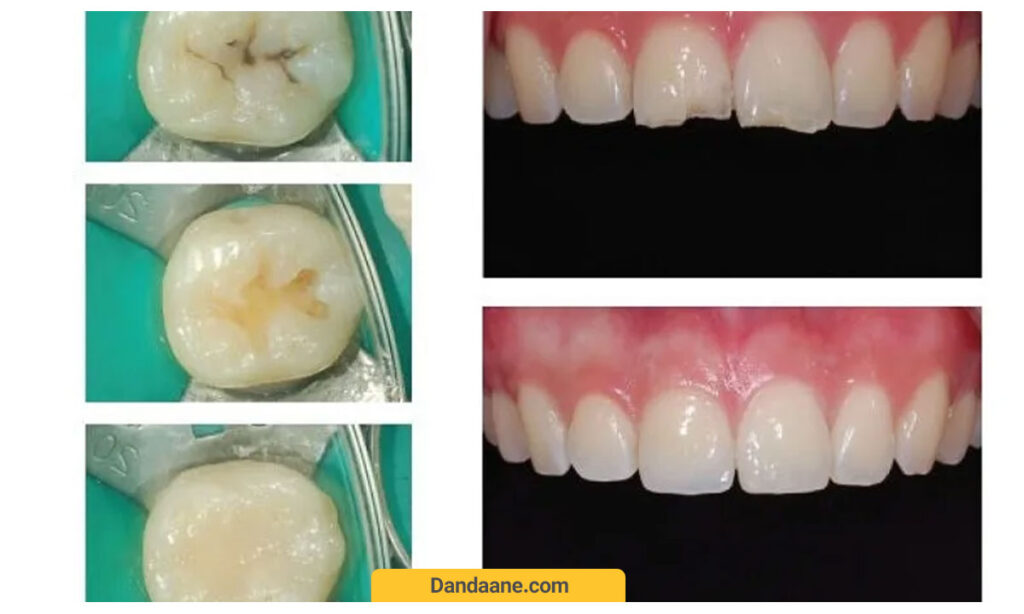 عکس کامپوزیت نانوهیبرید
