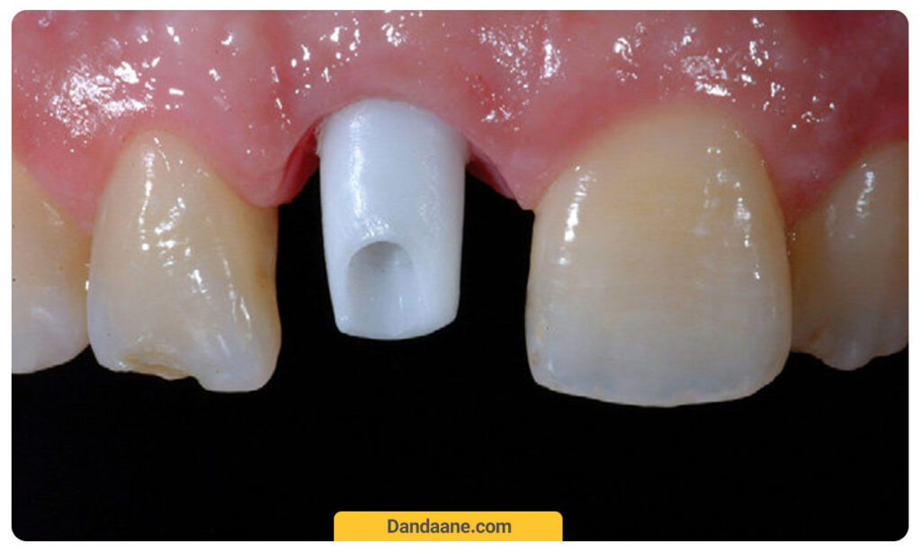 قرار دادن اباتمنت ایمپلنت در لثه