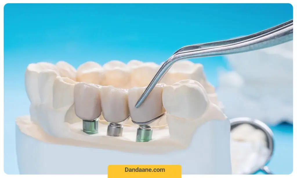 کاشت ایمپلنت دندان