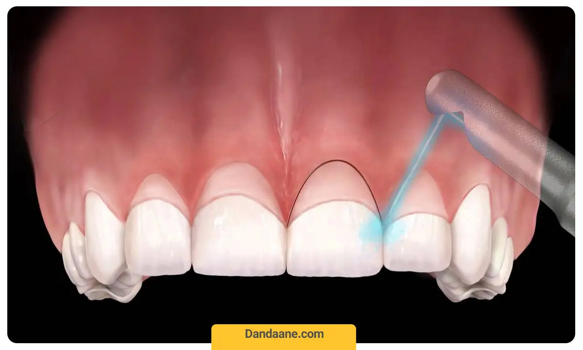 جراحی کاهش بافت لثه