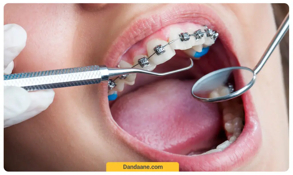 معاینه دندانپزشک از براکت های ارتودنسی 