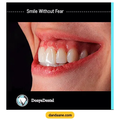 نمونه کار ترمیم و زیبایی دندان کلینیک دندانپزشکی دنیا دنتال