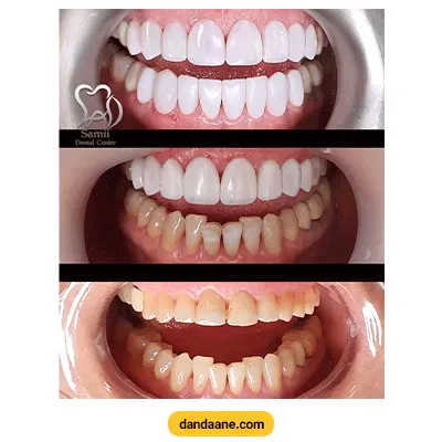 نمونه کار خدمات زیبایی دندان توسط دکتر مهدی سمیعی