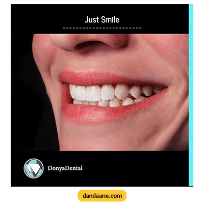 نمونه کار درمان ترمیم و زیبایی دندان کلینیک دندانپزشکی دنیا دنتال