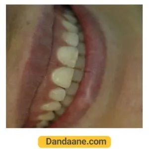 نمونه کار قبل لمینت دندان دکتر ماهور قربانی