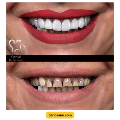 نمونه کار قبل و بعد ترمیم و زیبایی دندان دکتر مهدی سمیعی