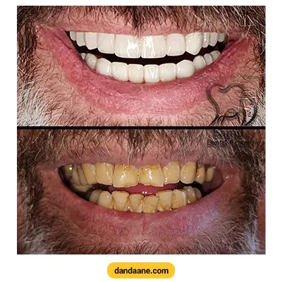 نمونه کار قبل و بعد سفید کردن دندان ها توسط دکتر مهدی سمیعی