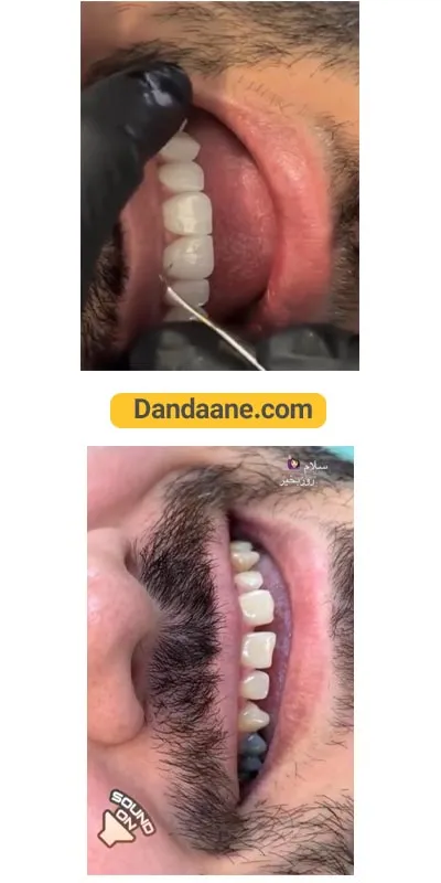 نمونه کار قبل و بعد لمینت دندان دکتر ماهور قربانی