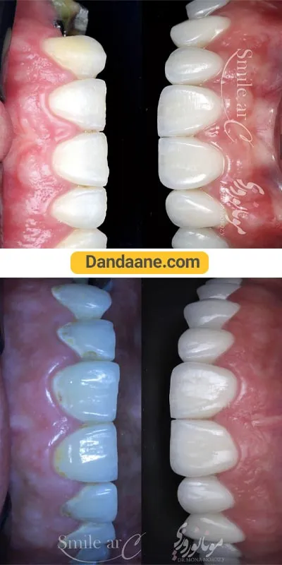 نمونه کار قبل و بعد لمینت دندان دکتر مونا نوروزی