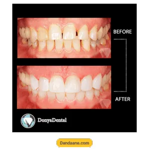 نمونه کار قبل و بعد کامپوزیت کلینیک دندانپزشکی دنیا دنتال