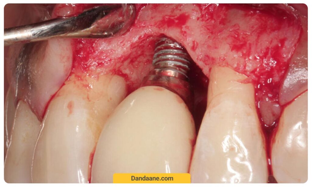 پری ایمپلنتیت