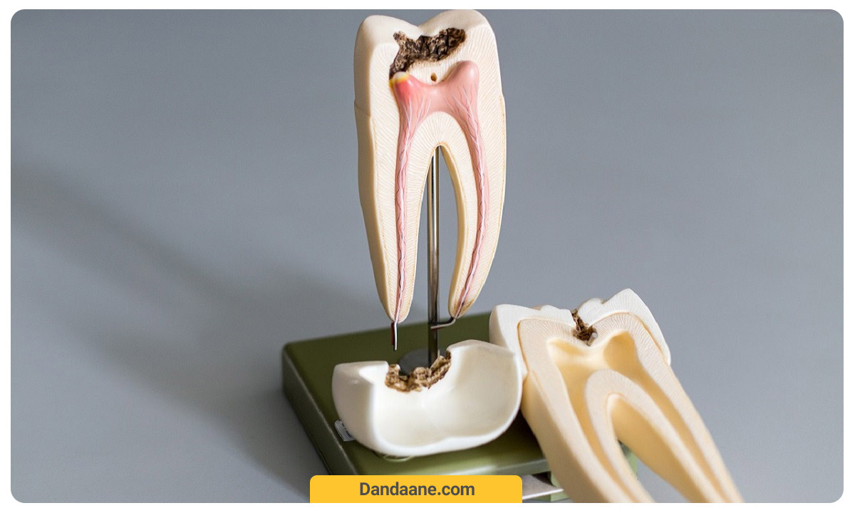 در هنگام پوسیدگی دندان امکان ترمیم وجود نخواهد داشت و دندان باید کشیده شود
