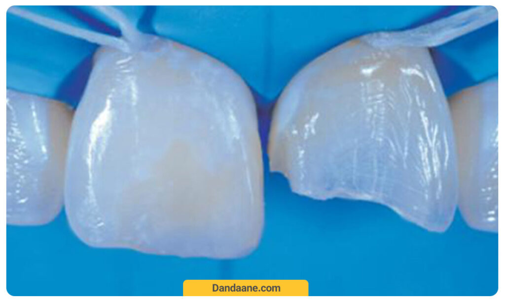 کامپوزیت ماکروفیل