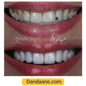 یک نمونه کار دیگر از قبل و بعد نصب لمینت دندان توسط دکتر مونا نوروزی