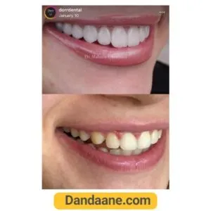 یک نمونه کار دیگر قبل و بعد لمینت دندان دکتر ماهور قربانی