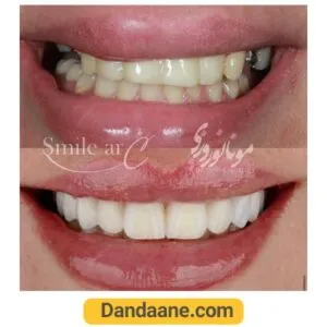 یک نمونه کار قبل و بعد لمینت دندان دکتر مونا نوروزی