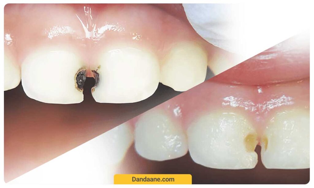 نکات فلورایدتراپی