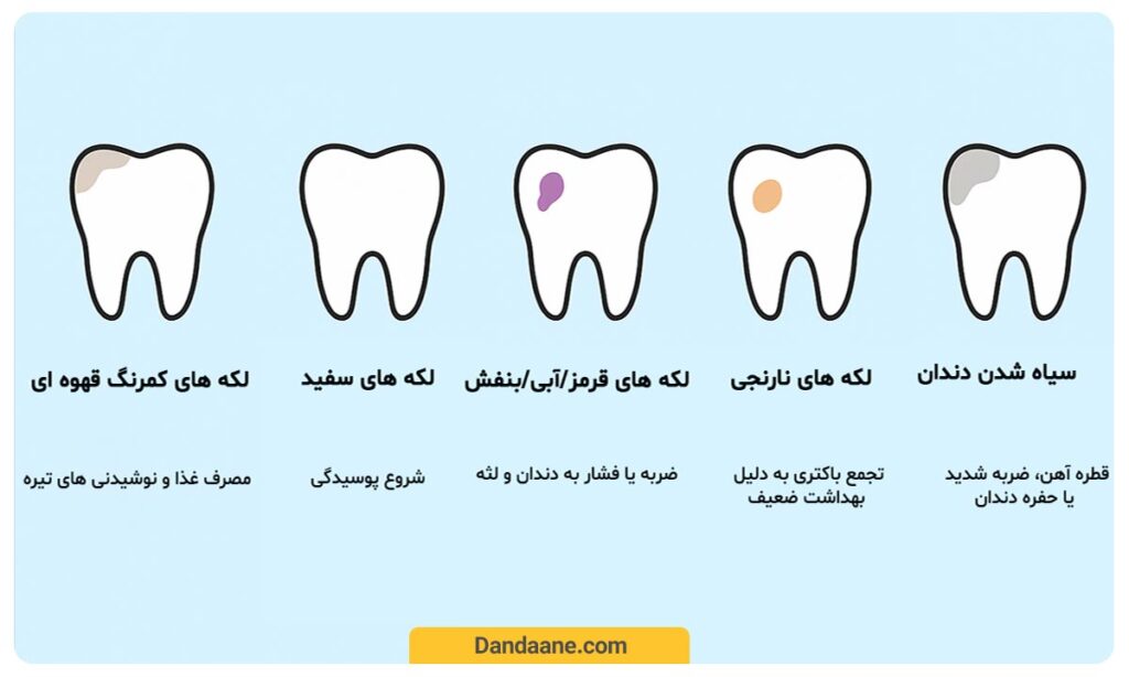 علائم سیاه شدن دندان کودک