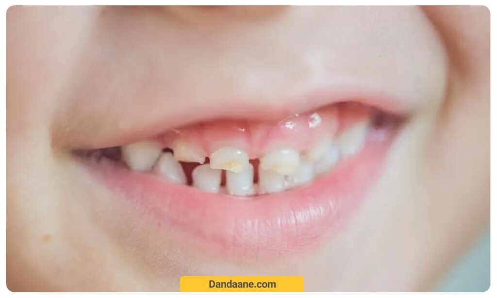 تغییر رنگ دندان کودکان