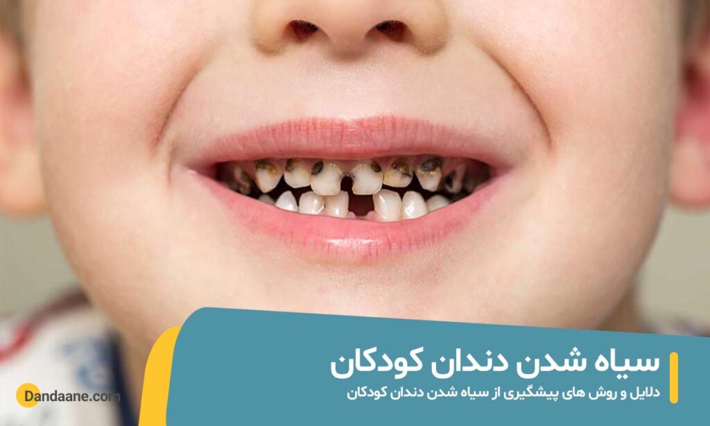 بررسی علت و درمان سیاه شدن دندان کودکان
