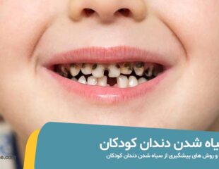 بررسی علت و درمان سیاه شدن دندان کودکان