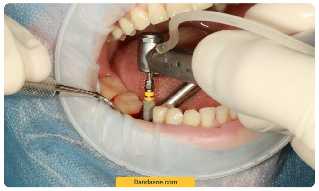 عکسی از قرار دادن پایه ایمپلنت در لثه