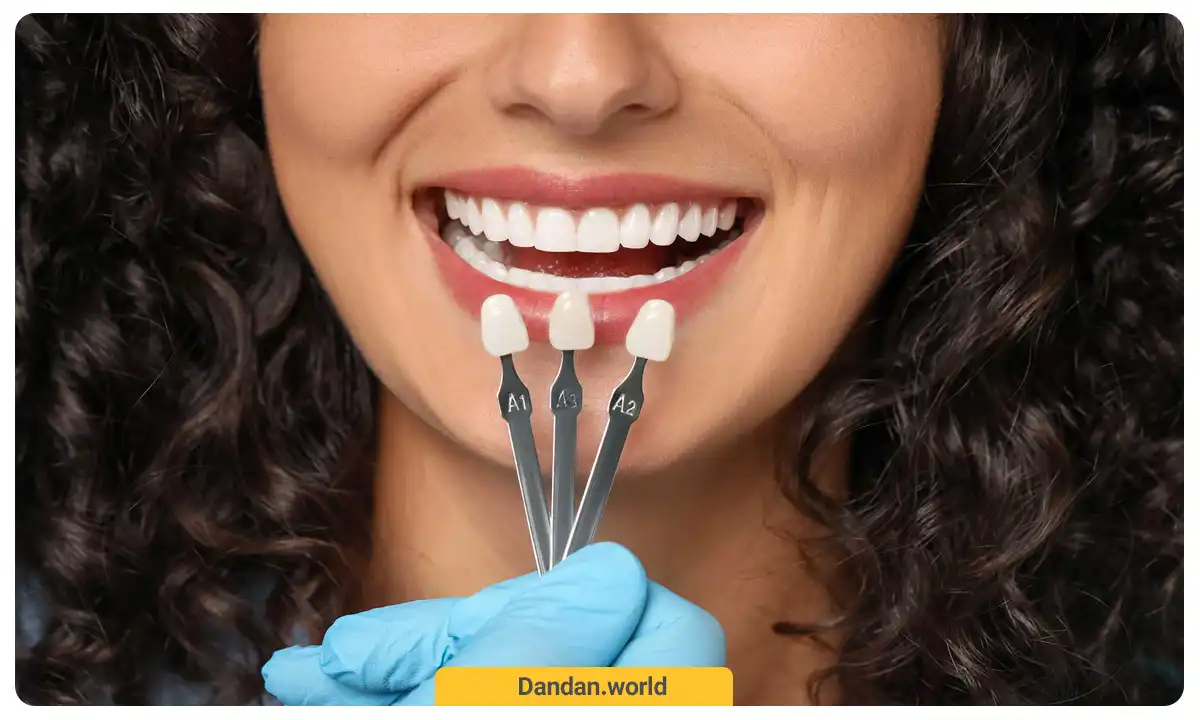 درمان شکستگی دندان با ونیر