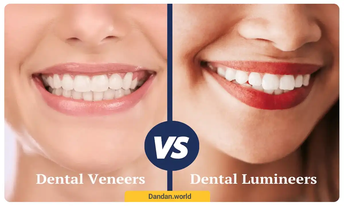 ونیر پرسلین یا لمینت سرامیکی دندان